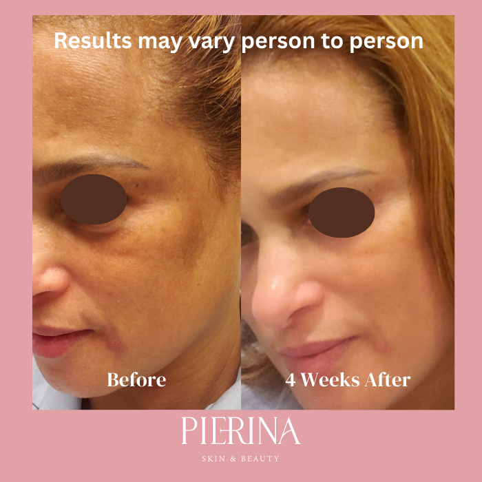 Anti-Melasma Even Skin System
