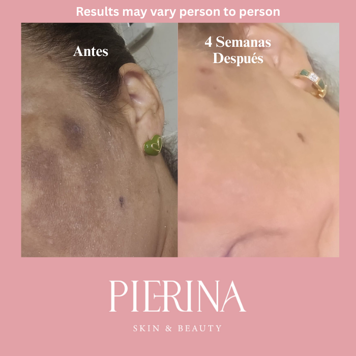 Anti-Melasma Even Skin System
