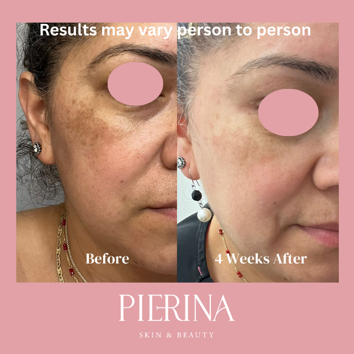 Anti-Melasma Even Skin System