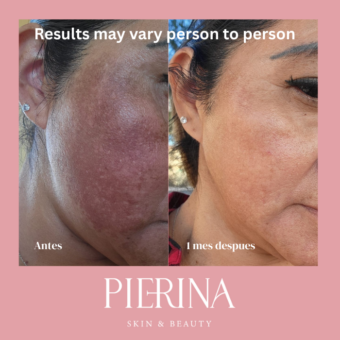 Anti-Melasma Even Skin System