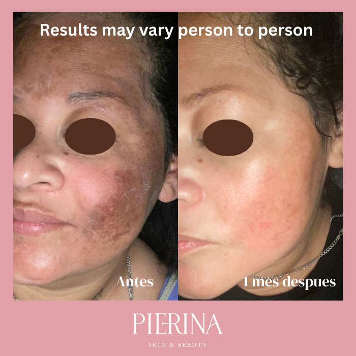 Anti-Melasma Even Skin System