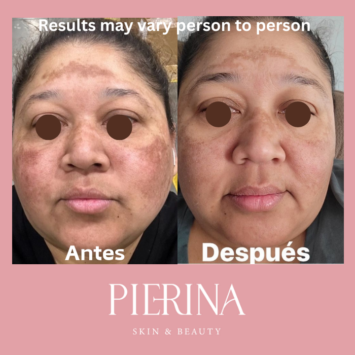 Anti-Melasma Even Skin System